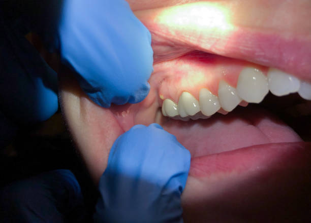 Best Emergency Denture Repair in Ly Lake, IL